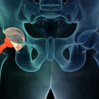 Signs That Your Hip Replacement Has Failed