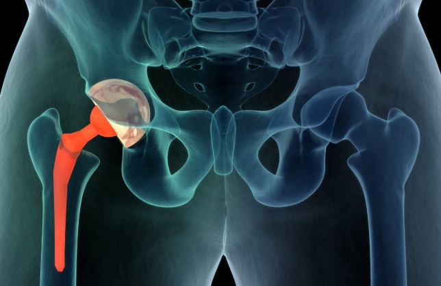 Signs That Your Hip Replacement Has Failed